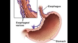 Esophageal Varices [upl. by Intruoc]