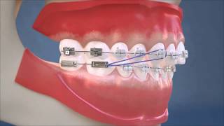 Class II Elastics  Lateral View HD Edition [upl. by Yemane907]