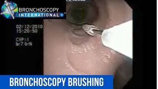 Flexible Bronchoscopy Introduction 8  Awake Intubation Part 1 [upl. by Theurich]