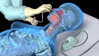 Flexible Bronchoscopy Medical Definition  Quick Overview [upl. by Eeresid237]