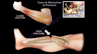 Types amp Mechanism Of Fractures  Everything You Need To Know  Dr Nabil Ebraheim [upl. by Limaa]