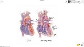 Pulmonary Atresia [upl. by Artnoed]