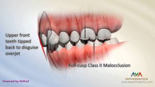 Malocclusion  Class II Div 2 [upl. by Ynatsed]