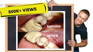 Class II cavity restoration  STEPBYSTEP [upl. by Ydal95]