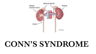 Conns syndrome  Hyperaldosteronism [upl. by Ruskin721]