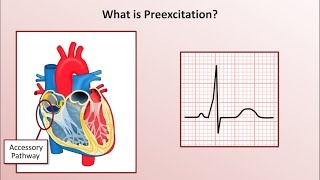 Advanced EKGs  WolffParkinsonWhite WPW Syndrome [upl. by Niliac]