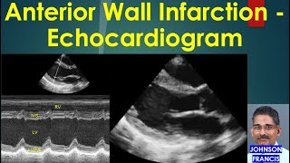 Anterior Wall Infarction Echocardiogram [upl. by Buroker545]