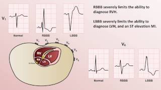 Intro to EKG Interpretation  Bundle Branch Blocks [upl. by Esilehc]