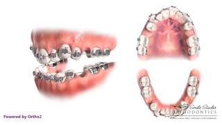 4 Second Bicuspid Extraction  Orthodontic Treatment [upl. by Mcripley440]