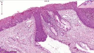 HSIL  High Grade Squamous Intraepithelial Lesion  Histopathology [upl. by Seibold]