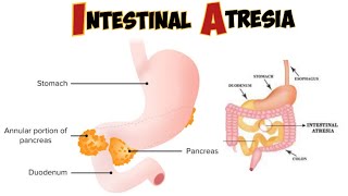 Intestinal atresia amp stenosis [upl. by Notgnimer]