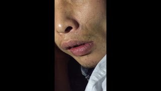 Orofacial Dyskinesia [upl. by Chavaree447]