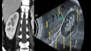 Ultrasonido de Riñones lo básico [upl. by Neelrad152]